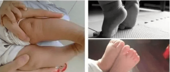 畸形|脑瘫患者为什么会出现足畸形？与哪些因素有关？