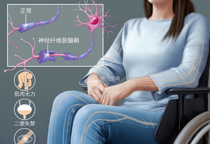 无能|不得了！早期发现的运动神经元病能活多久？