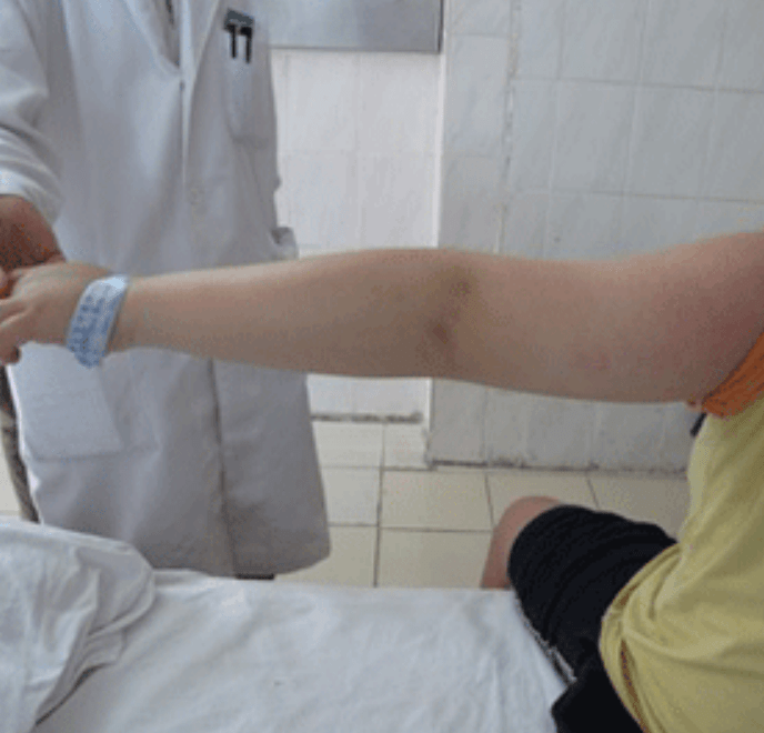 进行性肌营养不良症能活到几岁 23b1b12a02684b349116e8fdb972eec6.png