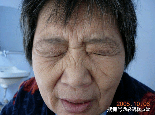 上海虹桥医院孙志领梅杰综合征的4大危害应该如何治疗