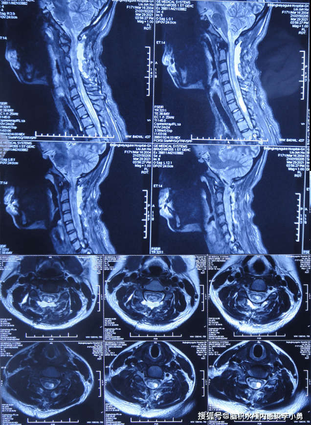 颈椎病检查报告图片图片