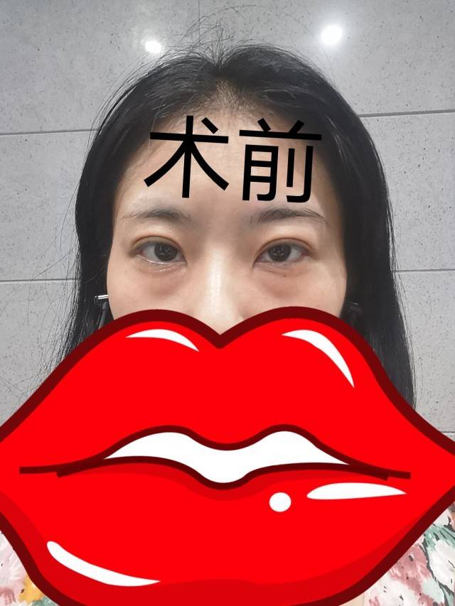 冰袋双眼皮术后护理小妙招