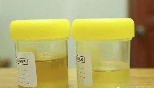 定性|导致尿蛋白高的原因有哪些