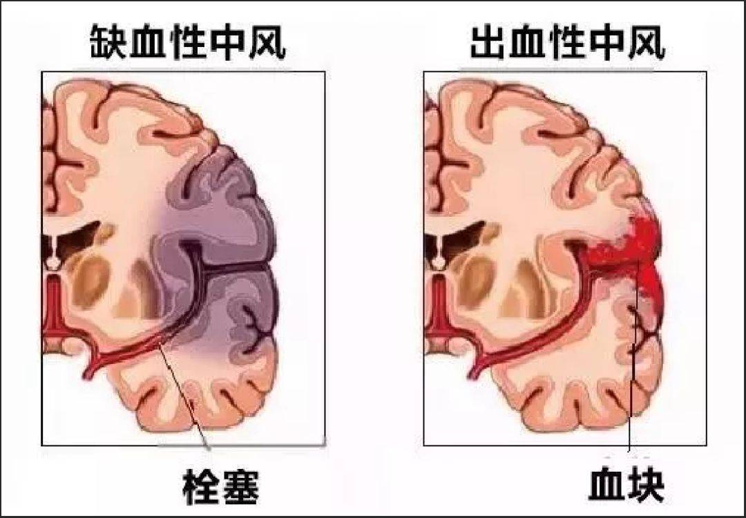 治疗|如何快速识别脑梗死？