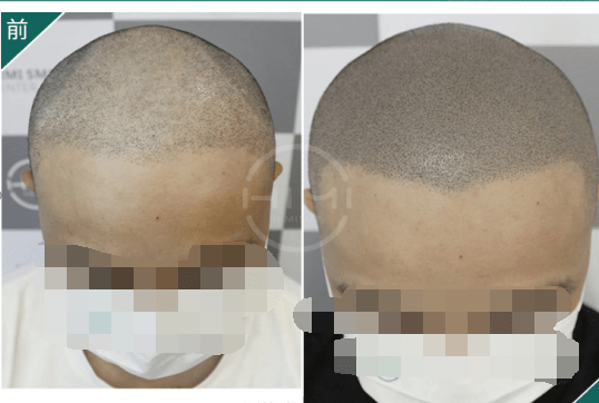 黑米3d纹发头发早白脱发可能是因为这个些原因