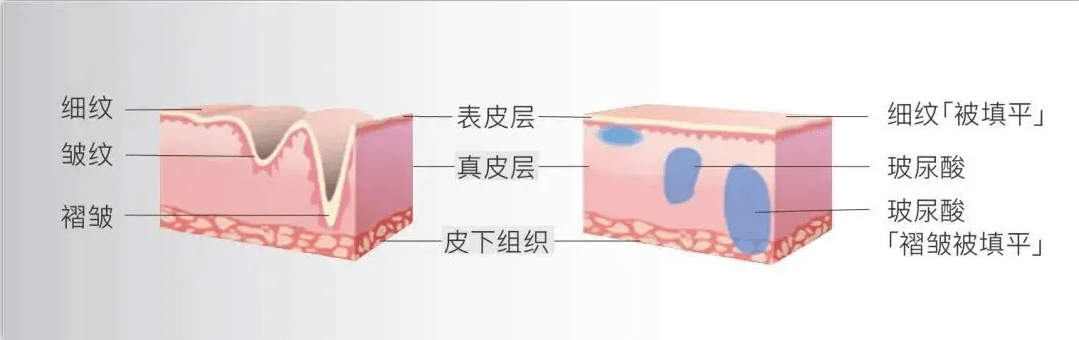 方法肉肉脸和干瘦脸，抗衰方法不一样，选对了才能快速变美