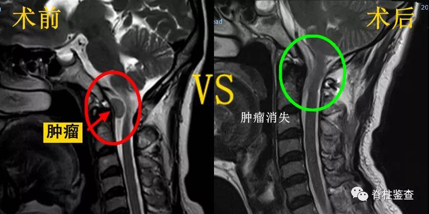 脊柱|“第二次重生”丨神经脊柱外科完成高难度颅颈交界区肿瘤手术