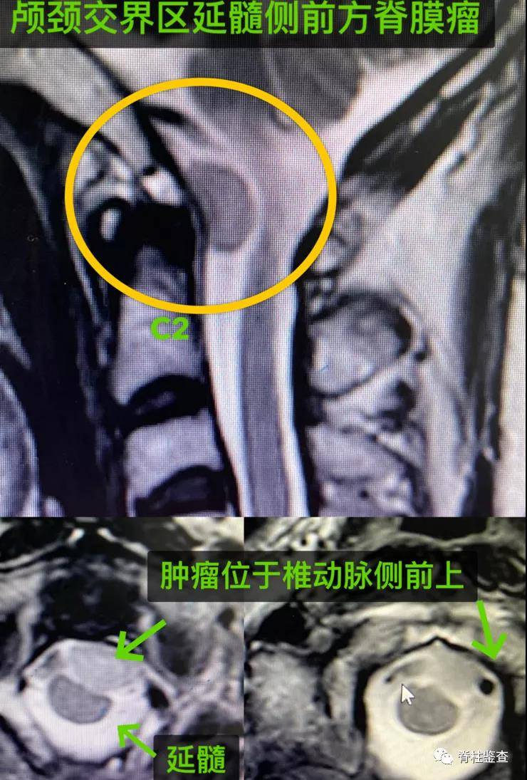 脊柱|“第二次重生”丨神经脊柱外科完成高难度颅颈交界区肿瘤手术