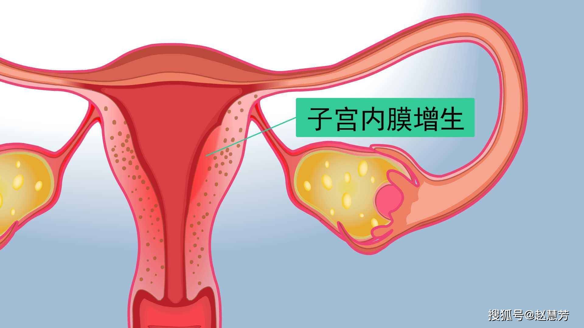 子宫内膜增厚要注意什么