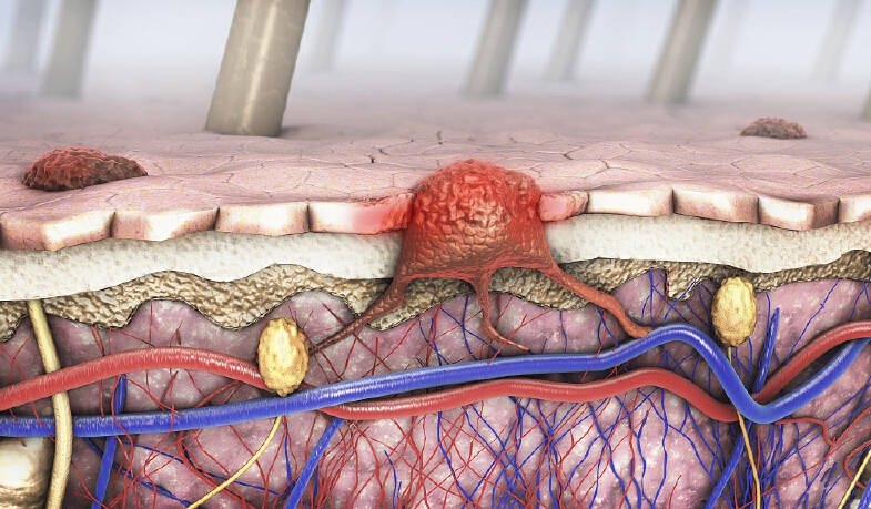 可以通过免疫细胞进行治疗吗?_癌变_恶性肿瘤_皮肤