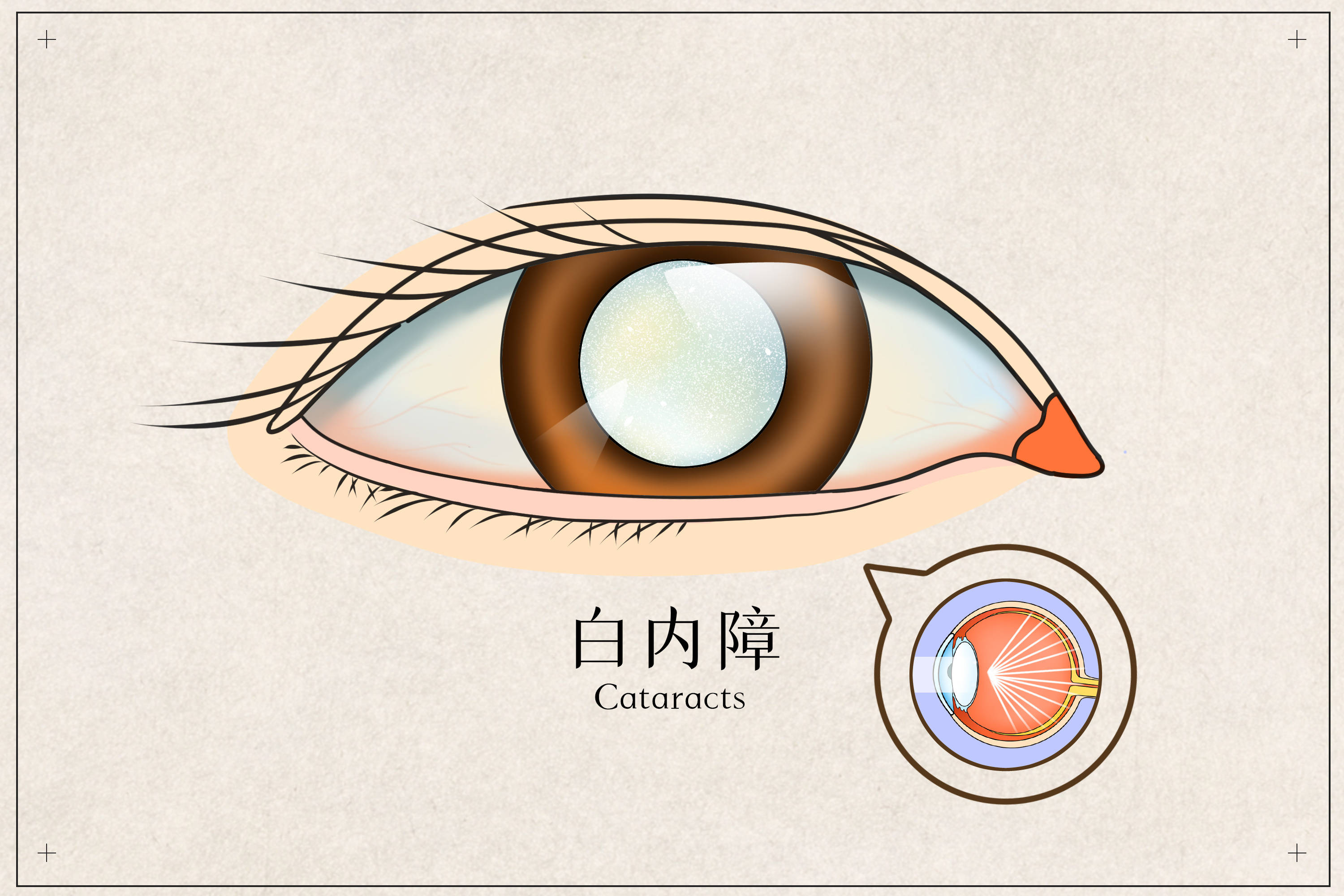 健康︱白内障合并眼底疾病，该如何选择治疗方式_手机搜狐网