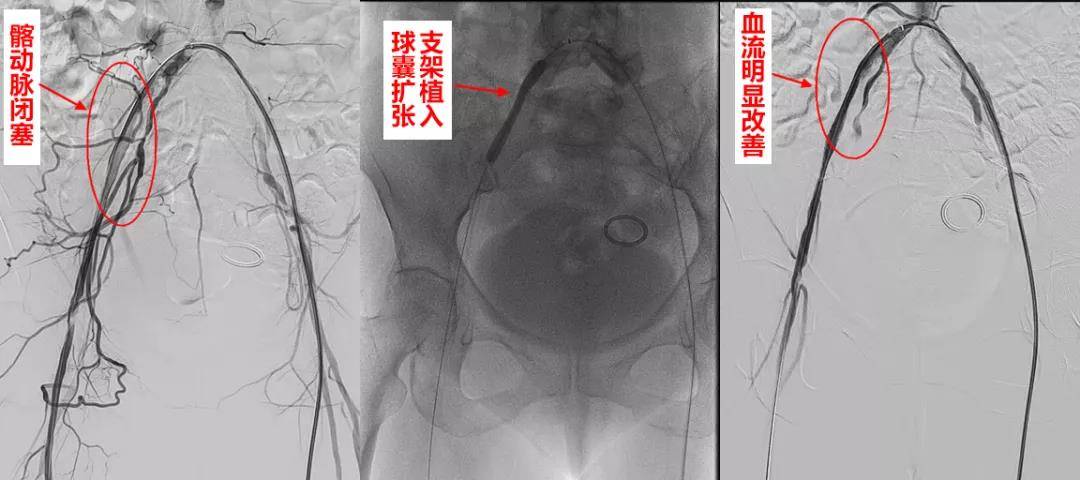 血管|人老先老腿，不过经常腿凉腿麻或许与衰老无关，而是患上了这个病……