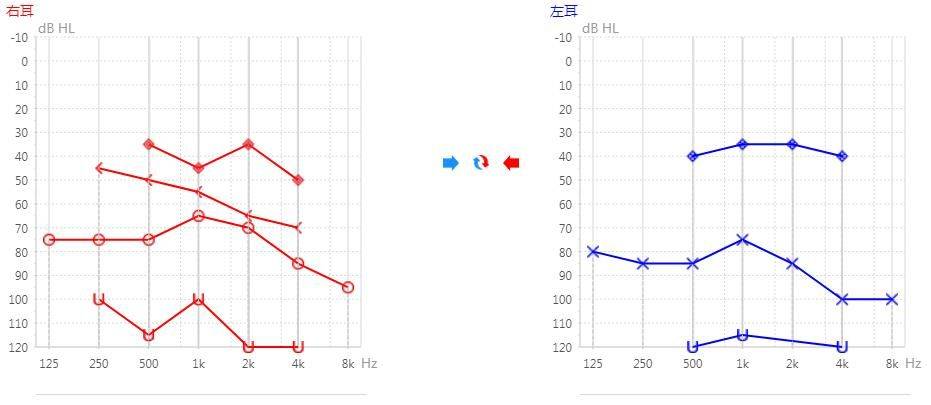 永川惠耳聽力分享聽見但聽不清言語識別率差那還有必要佩戴助聽器嗎