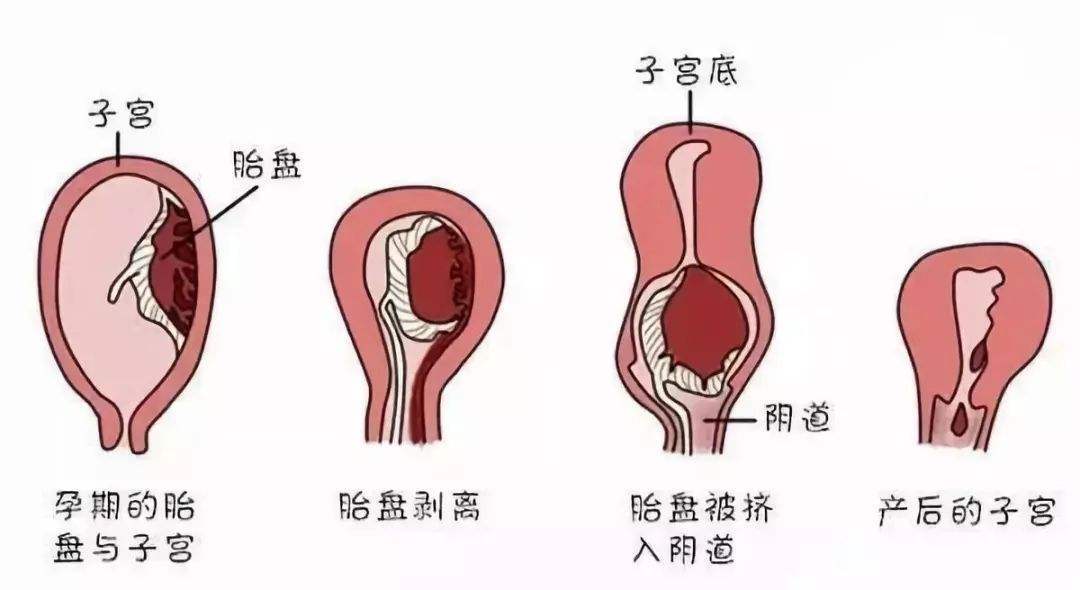 白色恶露因含大量白细胞