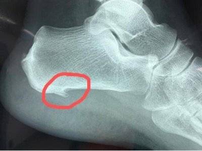 医生_治疗_脚跟