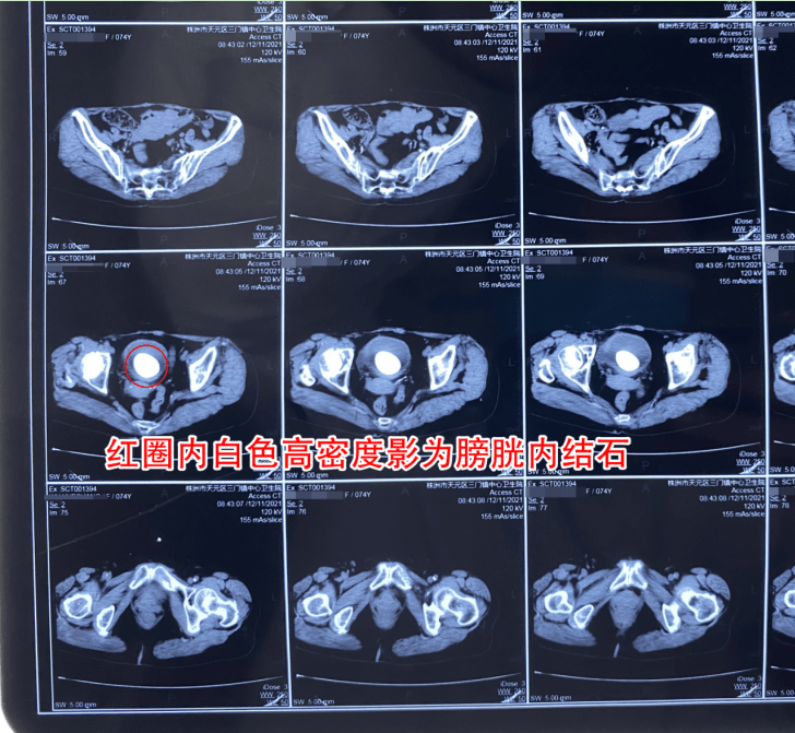 株洲|七旬娭毑频繁尿血、小便剧痛，检查发现膀胱竟有颗“鸡蛋大结石”