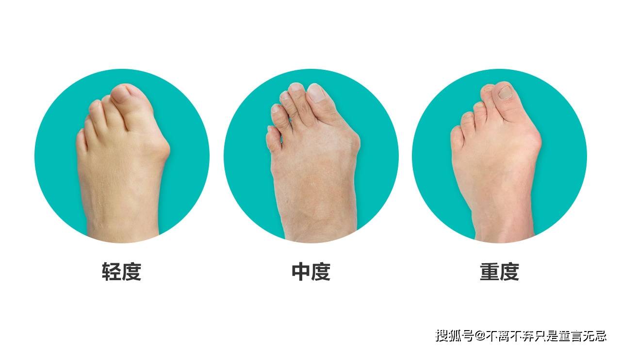 青少年_脚趾头_变形