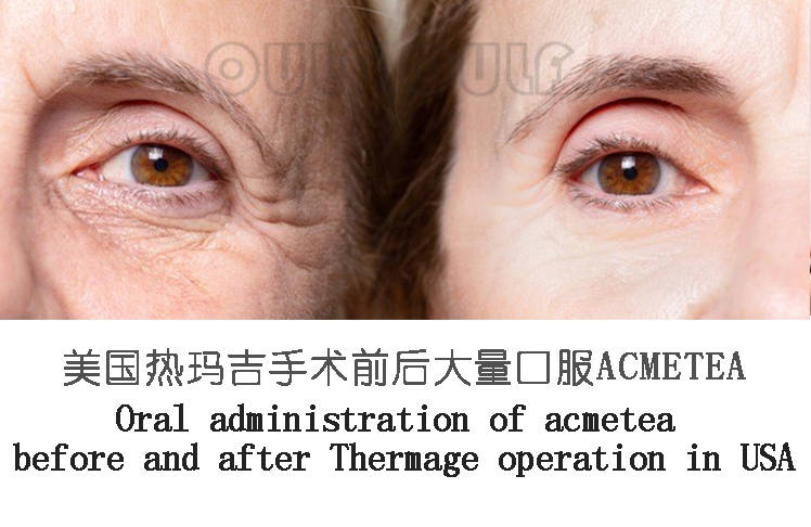 玛吉敲重点：做了热玛吉多久可以化妆，做了热玛吉以后要注意什么？