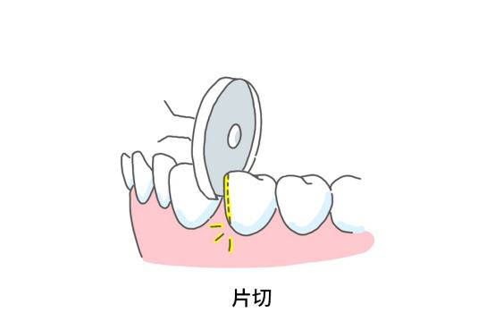 格伦菲尔杨阳医生邻面去釉牙齿片切常见的4个问题