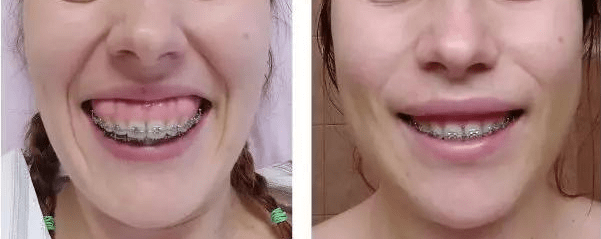 为什么有人一笑就露牙龈