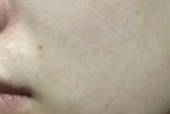 症状脂溢性皮炎和过敏的区别，真的很明显！