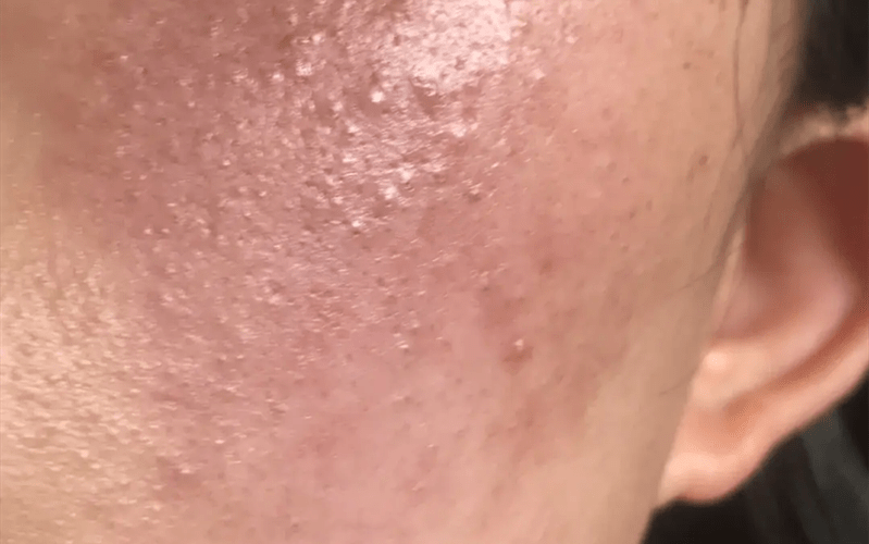 症状脂溢性皮炎和过敏的区别，真的很明显！