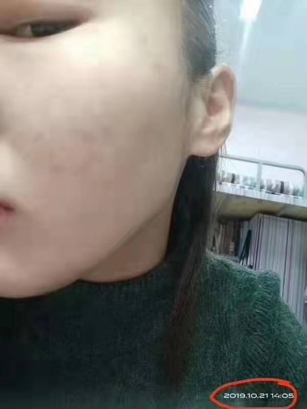 方法董欣薰衣草纯露消炎功效好嘛？痘痘肌敏感肌使用方法