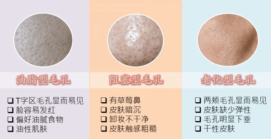 治疗皮肤李佳佳：毛孔粗大怎么办？