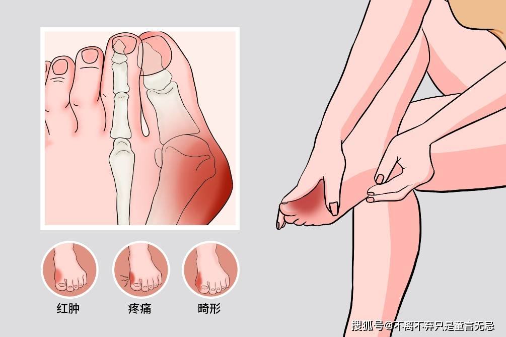 科普|北京丰台广济医院科普：大脚骨疾病如何预防?