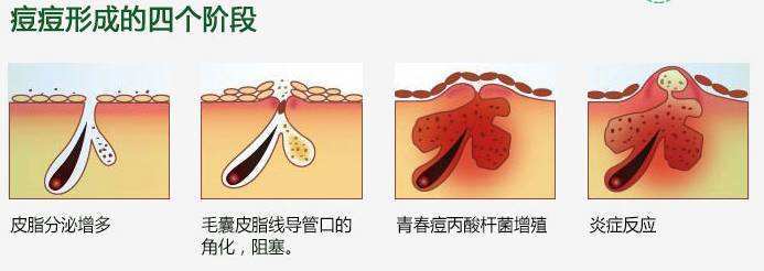 如痤疮,油性皮肤,头发干燥,黑头等,都与皮脂腺分泌过多,毛囊皮脂腺管