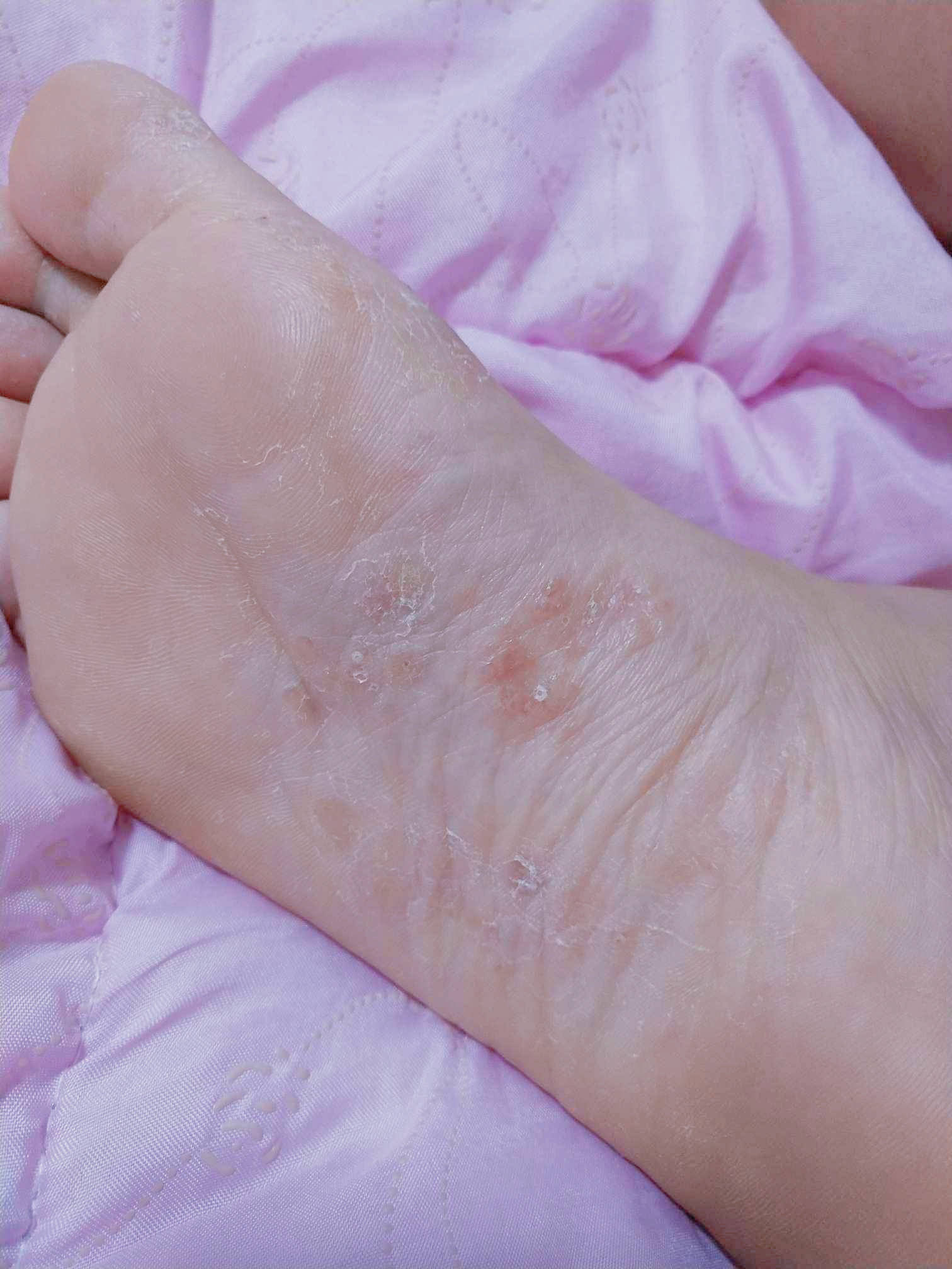 脚真菌感染的症状图片图片