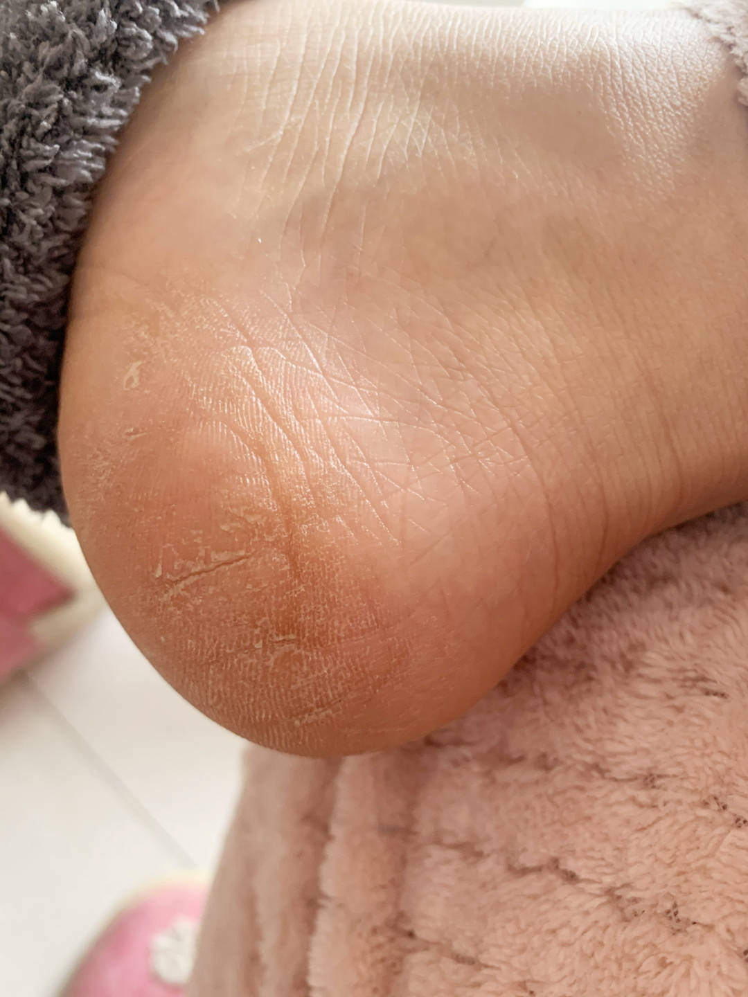 原创脚后跟干裂起硬皮裂口子怎么办不痒不臭