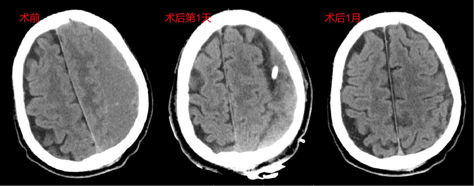 医学小常识老年人要警惕慢性硬膜下血肿