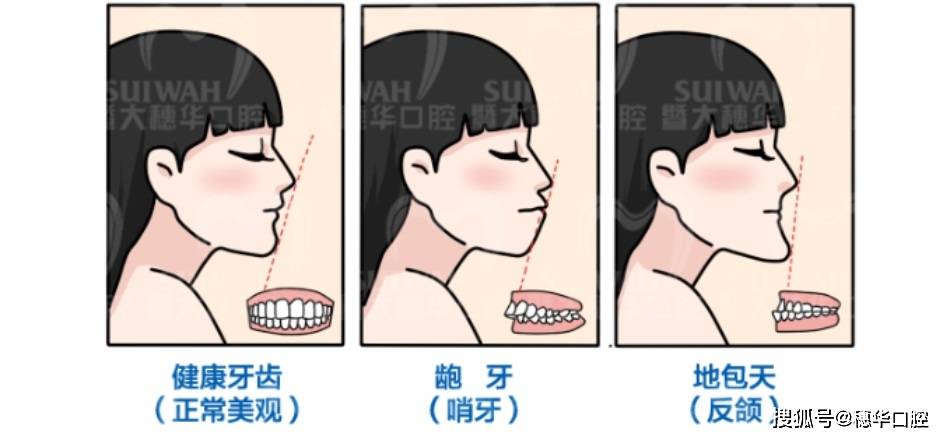 兒童換牙期出現暫時性的牙齒畸形問題需要早期干預嗎