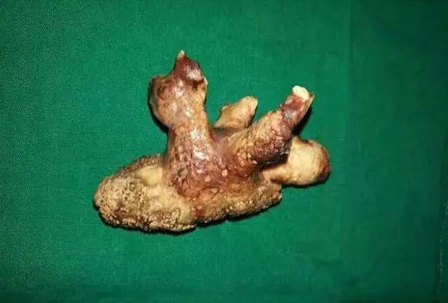 女子长期腰痛一查结石塞满肾脏,一文带你了解肾铸型结石_治疗_尿液