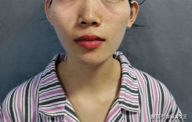 印第安纹4大雷区90的人都中过招这几种印第安纹改善方法不靠谱