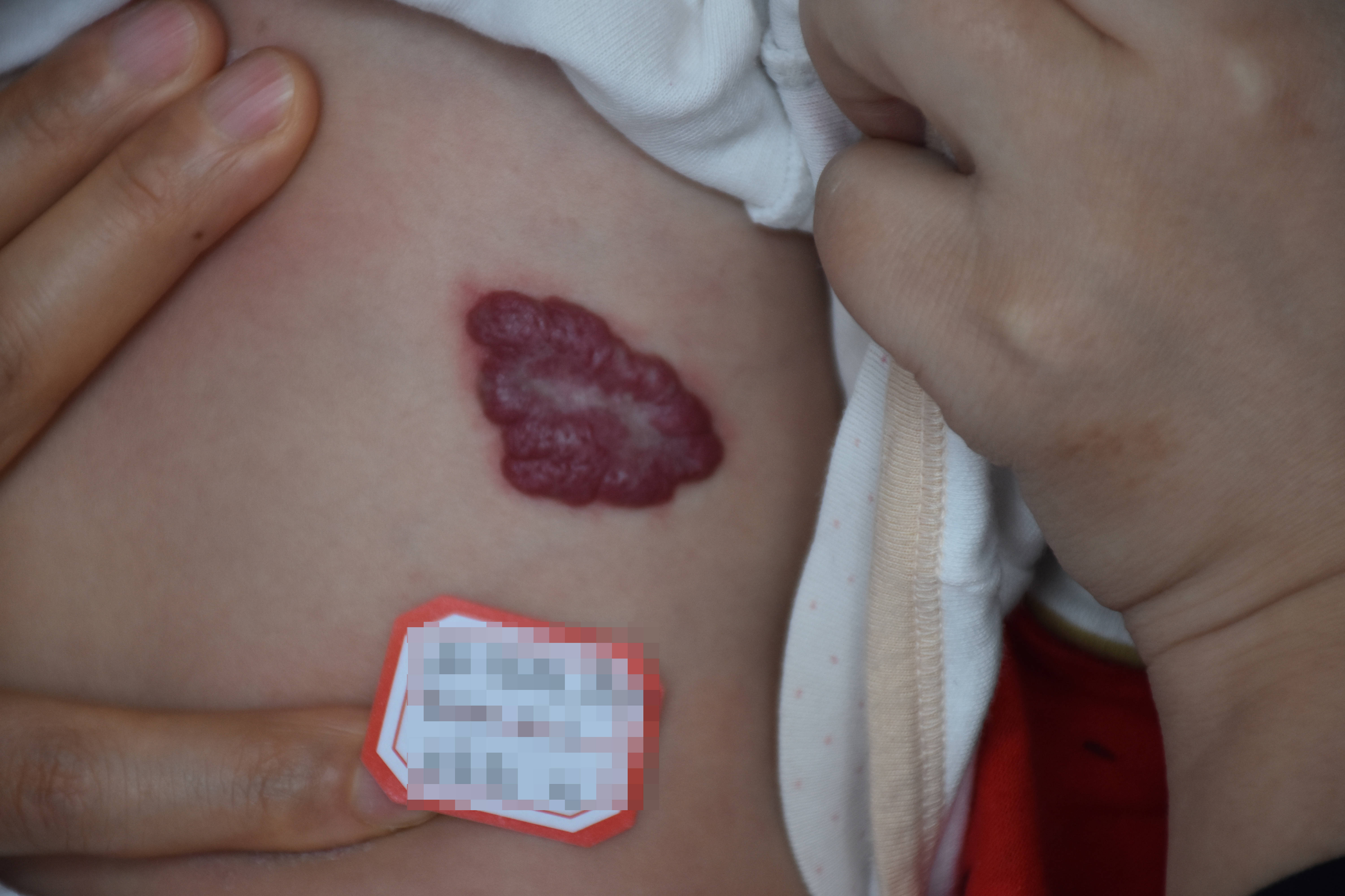 济南胎记血管瘤医院:草莓状血管瘤一定要治疗吗?
