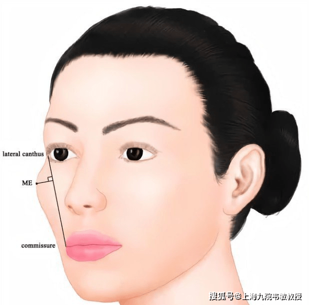 上海九院韦敏丨不同的颧骨形态类型,可能需要哪些改善