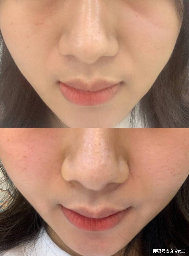 关于印第安纹剥离,你不知道的真相,这篇文章统统告诉你!