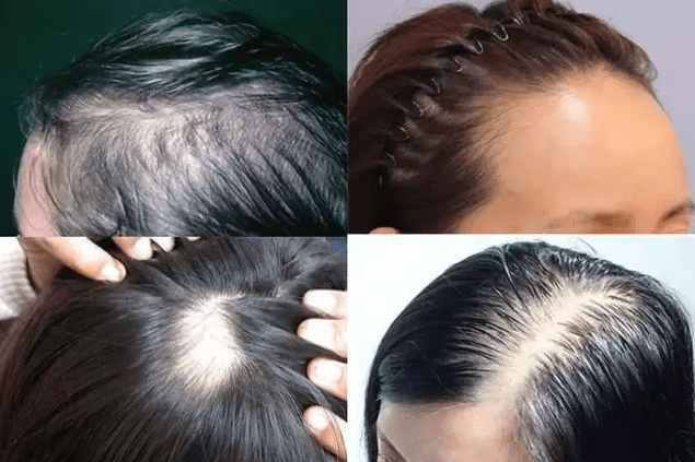 掉头发严重是什么原因女性怎么办缓解脱发3个方面要重视
