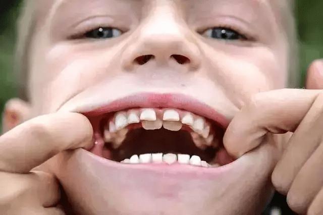 【乳牙滞留】儿童乳牙滞留的原因_乳牙滞留怎么办