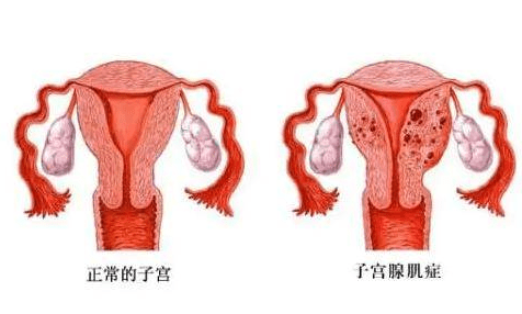 而子宫阴道畸形,比如残角子宫,纵隔子宫,阴道横隔等发育异常,会导致