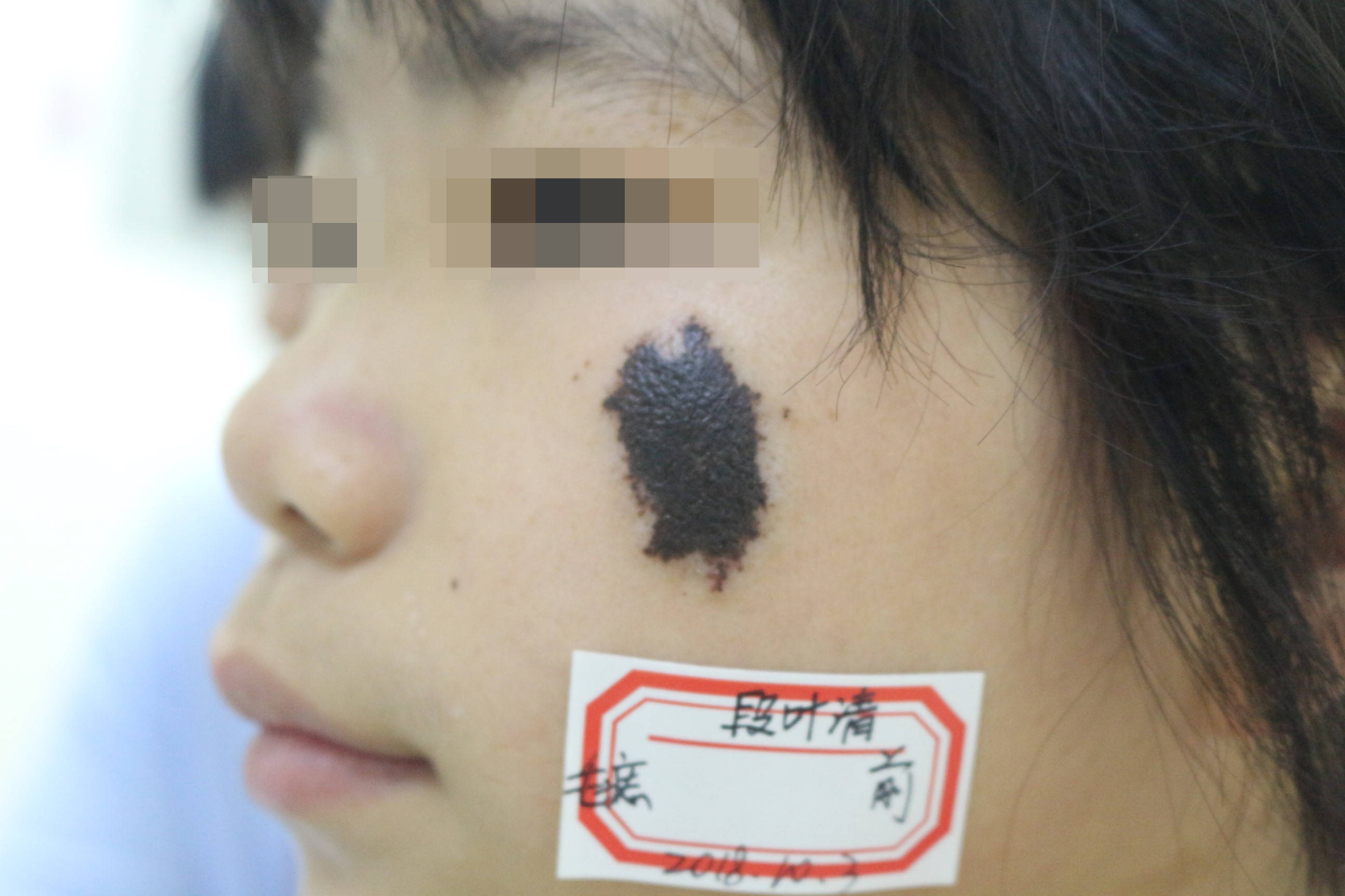 郑州市第二中医院科普:黑毛痣是怎么一回事?