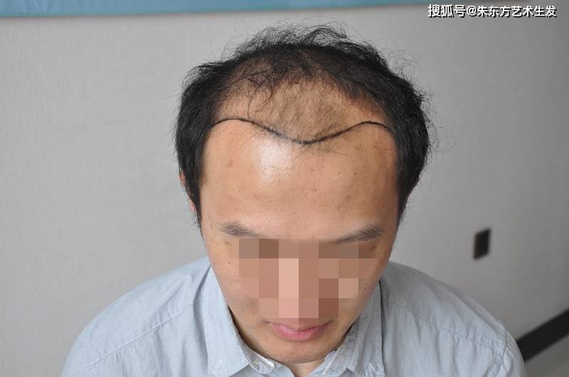 雄性激素脱发会遗传给下一代吗