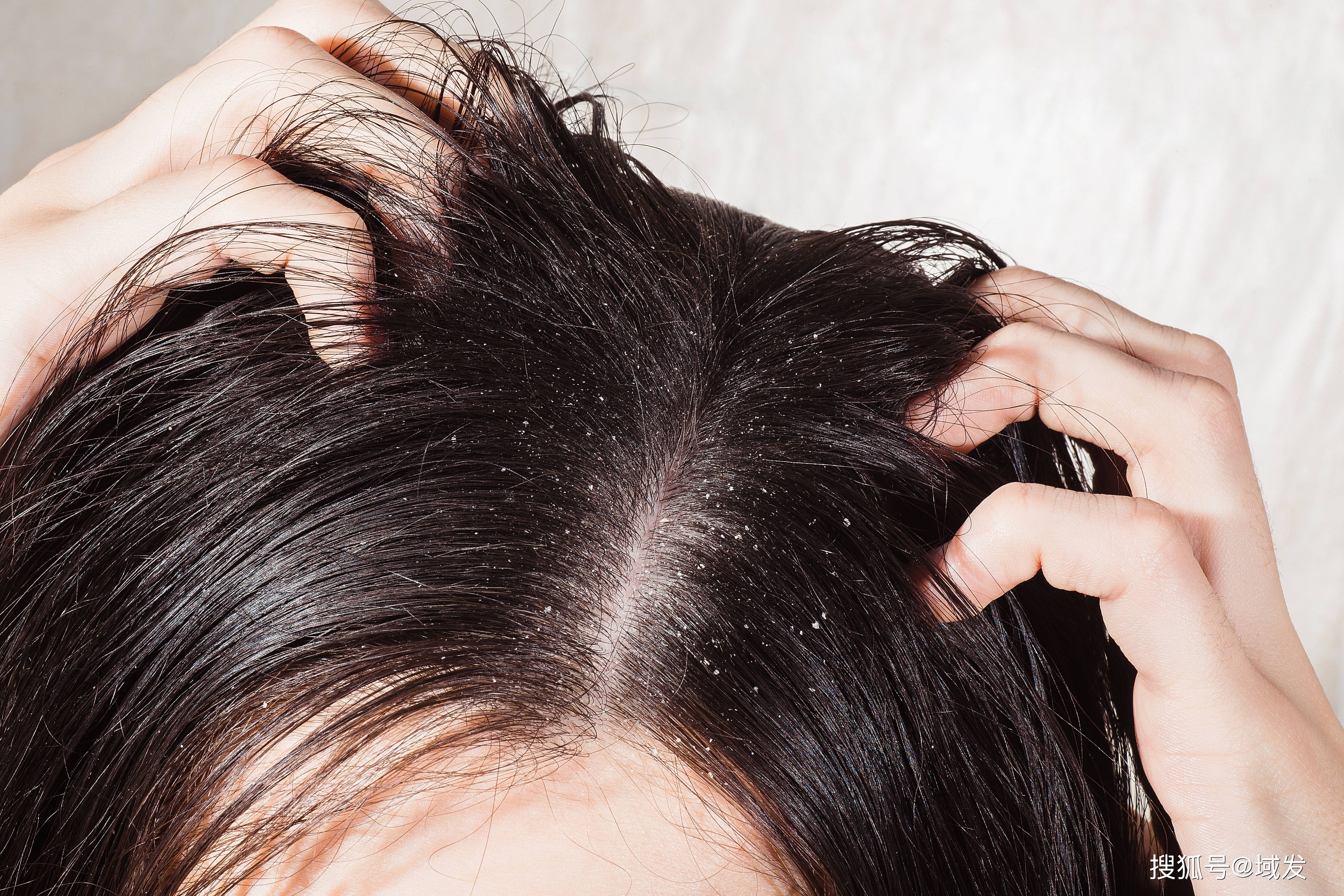 都可能是由于头皮敏感导致的如果头皮发红,瘙痒,干燥,紧绷,甚至掉发
