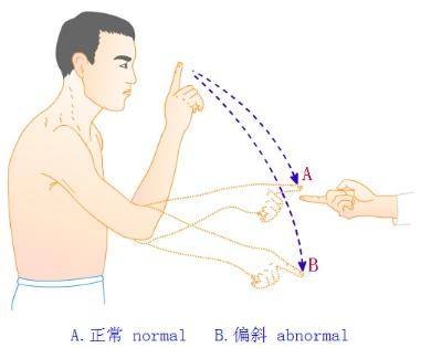 轮替试验:两手正反转圈,如果有异常,转圈会有交错或者打到自己.