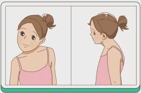 痉挛性斜颈俗称"歪脖子"那它会造成哪些伤害呢?_疗程_症状_患者