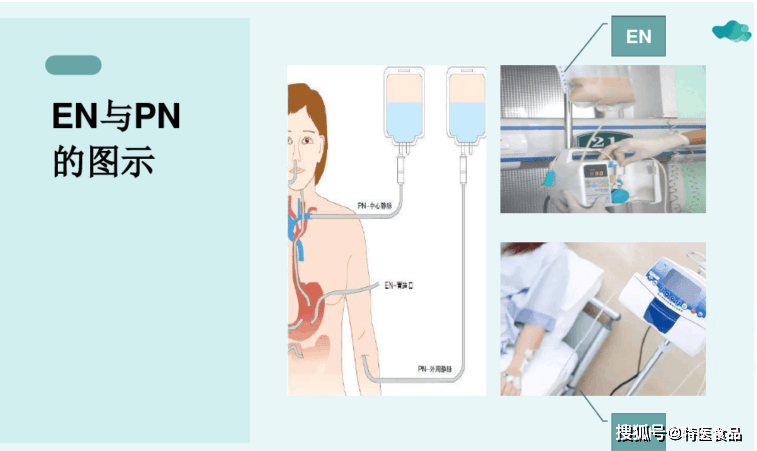 全部营养从肠外供给称全胃肠外营养(total parenteralnutrtion,tpn)2