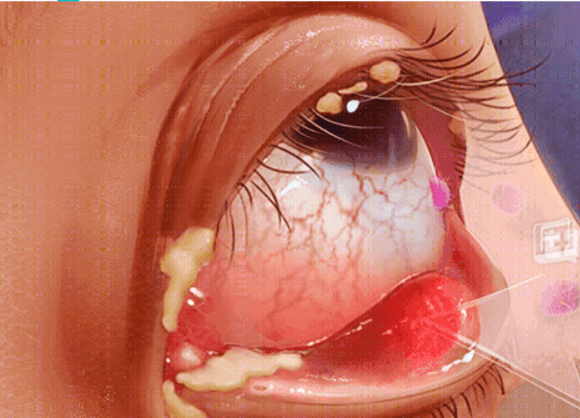 大角星的主要症状是高烧,感冒,咳嗽症状,然后是结膜炎,眼睛发痒,眼皮