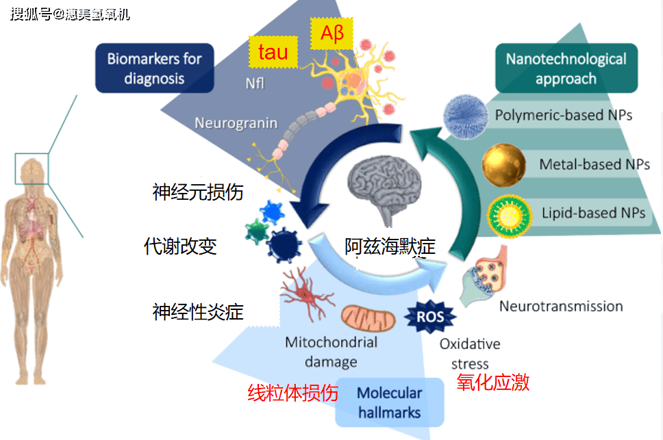 老年痴呆也叫阿兹海默症,病理学上,氧化应激和炎症是促成阿兹海默症的